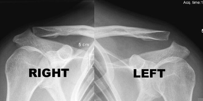 My X-ray showing a dislocated clavicle I sustained in a snowboarding accident