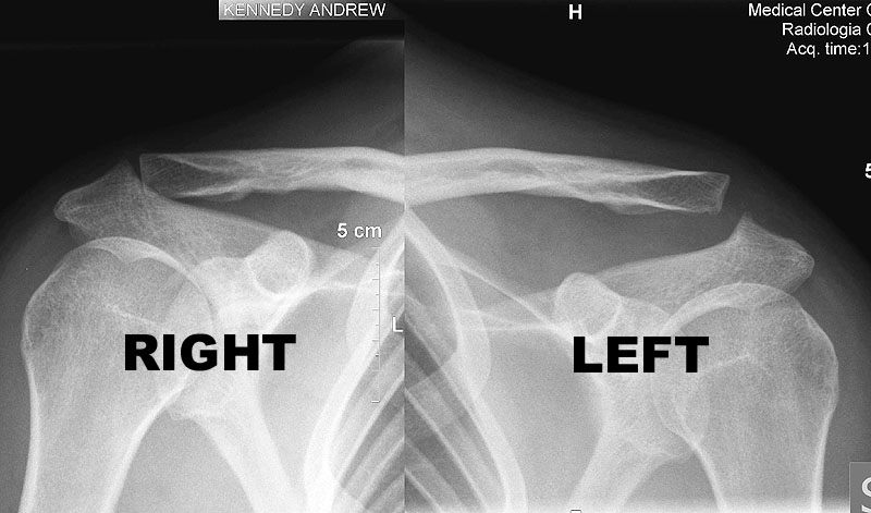 My X-ray showing a dislocated clavicle I sustained in a snowboarding accident